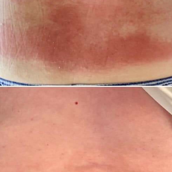 PREORDER ONLY ByeBye Stretch Marks,Mosquitos,Burns - Picture 11 of 16